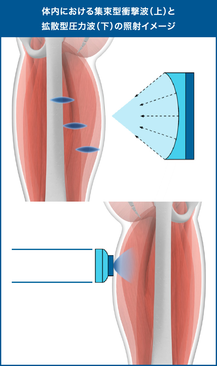 公式】衝撃波について｜集束型と拡散型の比較｜BTL-6000 フォーカス
